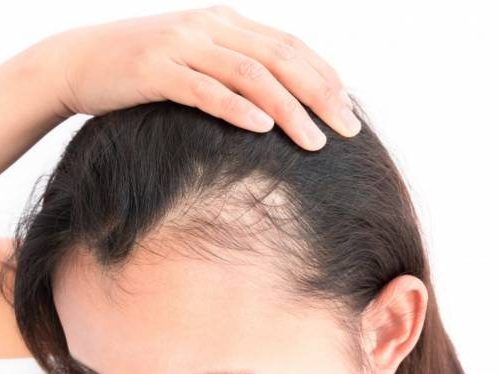 ۵ روش عملی برای جلوگیری از ریزش مو که باید بدانید !
