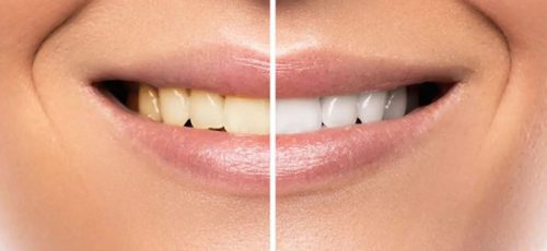 سفید کردن دندان | ۵ روش پزشکی و ۱۰ روش خانگی سفیدی دندان