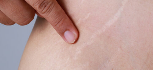 درمان ترک پوستی | چگونه ترک های پوستی را از بین ببریم؟