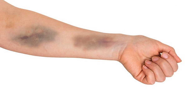 چرا بدن برخی افراد به راحتی کبود می‌شود؟ کبودی بی دلیل خطرناک است؟