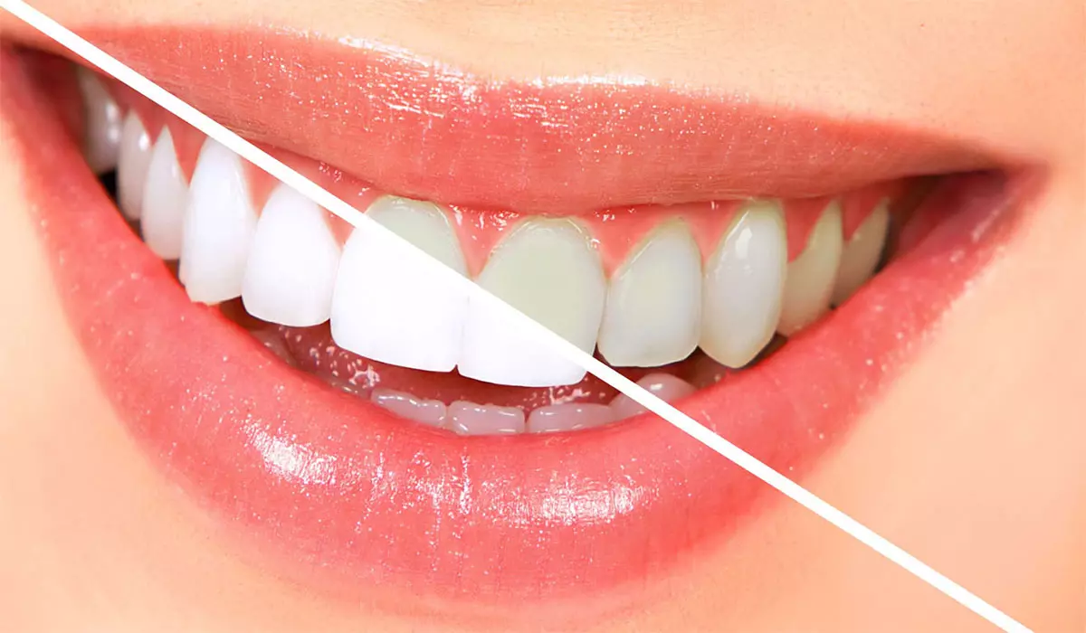 ۵ اشتباه رایجی که باعث زردی دندان ها می شود