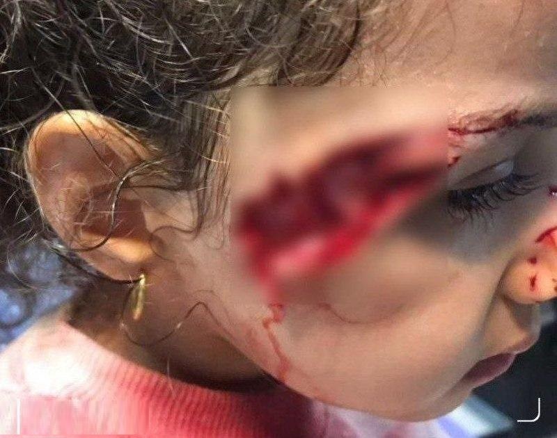 حمله سگ های ولگرد به دختر ۵ ساله در تبریز/ اگر همسایه ها نرسیده بودند !