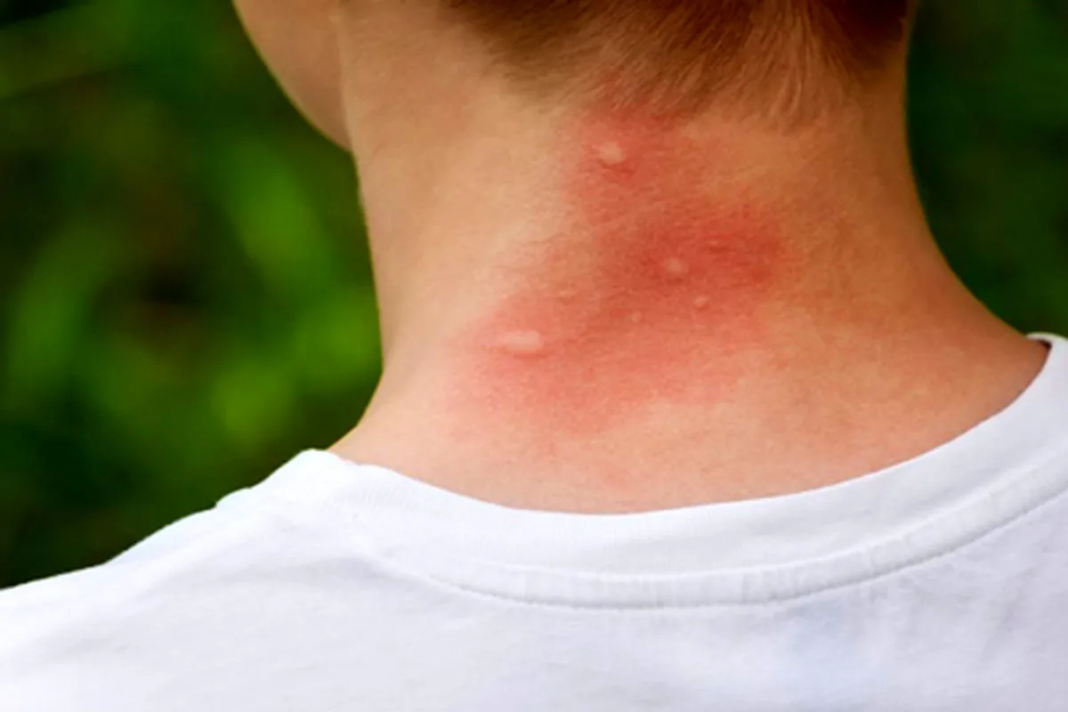 ۱۱ روش موثر برای جلوگیری از نیش حشرات در تابستان