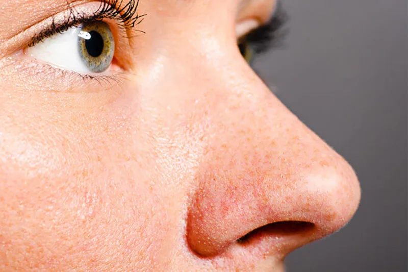 بهترین راه های خانگی برای از بین بردن و پاکسازی منافذ باز پوست بینی