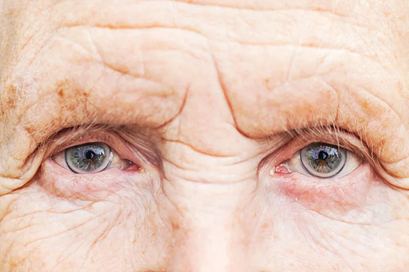امیدواری جدید به درمان کوری چشم در بین افراد مسن