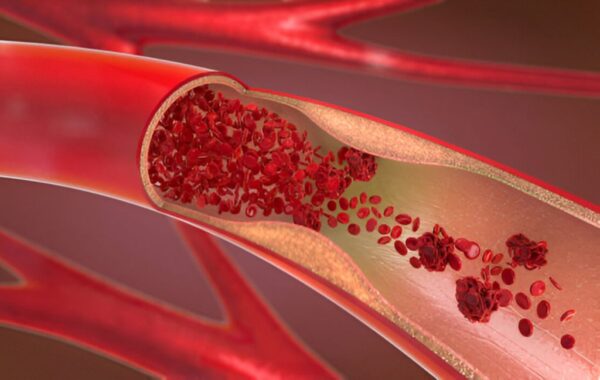 Which vitamin causes yellow skin 2