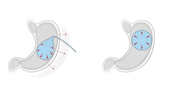 Gastric balloon for weight loss 2