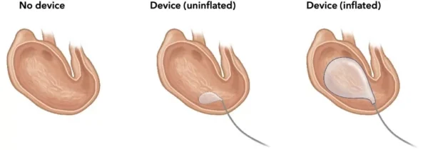 Gastric balloon for weight loss 3