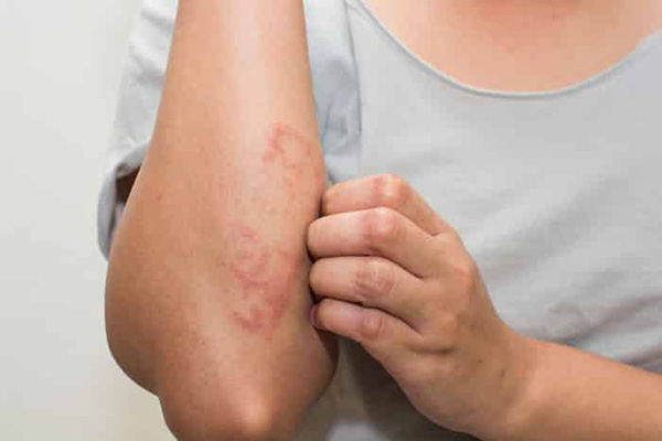 نشانه حساسیت و آلرژی به توت فرنگی