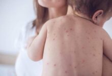 Symptoms of measles in children and infants1