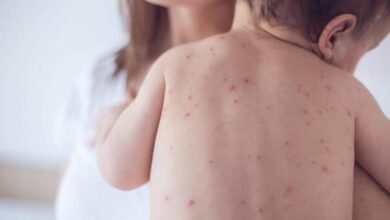 Symptoms of measles in children and infants1