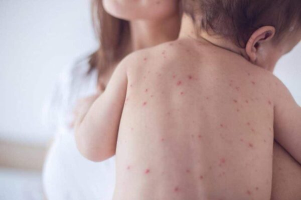Symptoms of measles in children and infants1