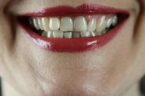لمینت دندان، بهترین راه اصلاح لبخند