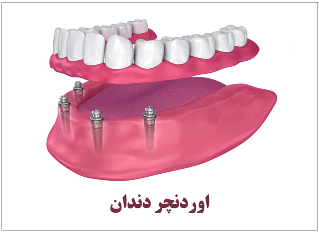 اوردنچر دندان