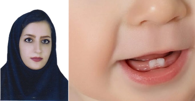 متخصص دندانپزشکی کودکان: رویش دندان یک فرآیند طبیعی است؛ والدین با آگاهی از نکات لازم، اضطراب را کاهش دهند