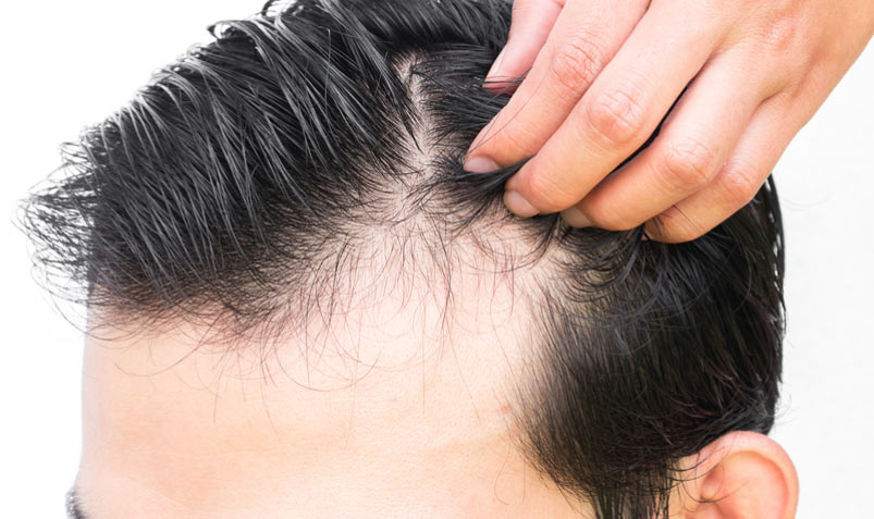توضیح متخصص پوست درباره دلایل شایع ریزش مو