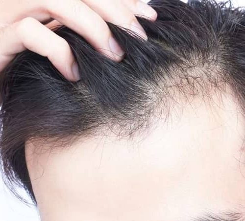 راهکار‌های طب سنتی جهت جلوگیری از ریزش مو