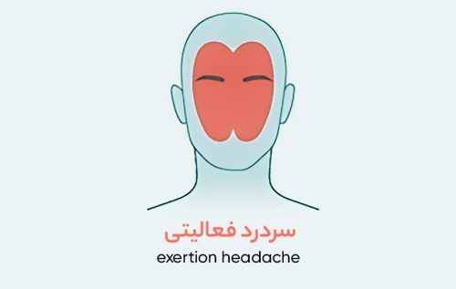 درد در هر بخش از سر نشانه‌ی چیست؟ انواع سردرد بر اساس محل درد