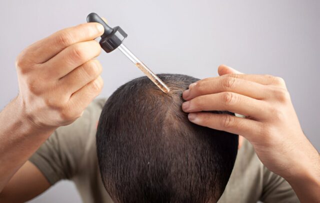 hormonal hair loss 4