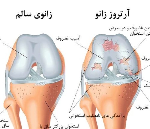 علل ، عوارض و نحوه درمان آرتروز یا سائیدگی زانو