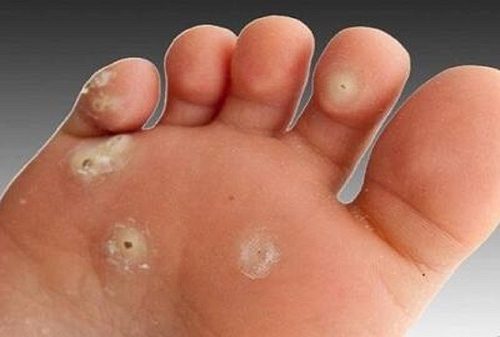 سه روش طلایی برای درمان قطعی میخچه کف پا